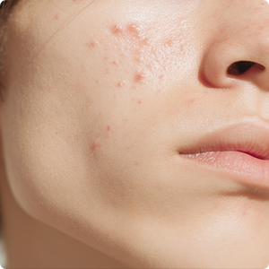 Acne & Breakouts